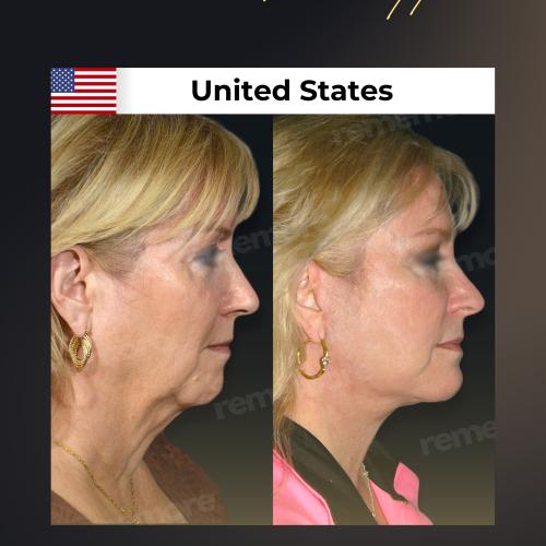 Photos Avant / Après 7